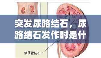 突发尿路结石,尿路结石发作时是什么症状?